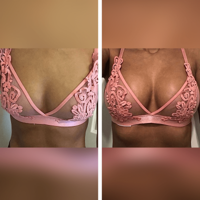 How Much Is A Boob Job?, Breast Augmentation Surgery Cost in UK