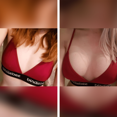 Breast Augmentation: From A to a D (Part B)