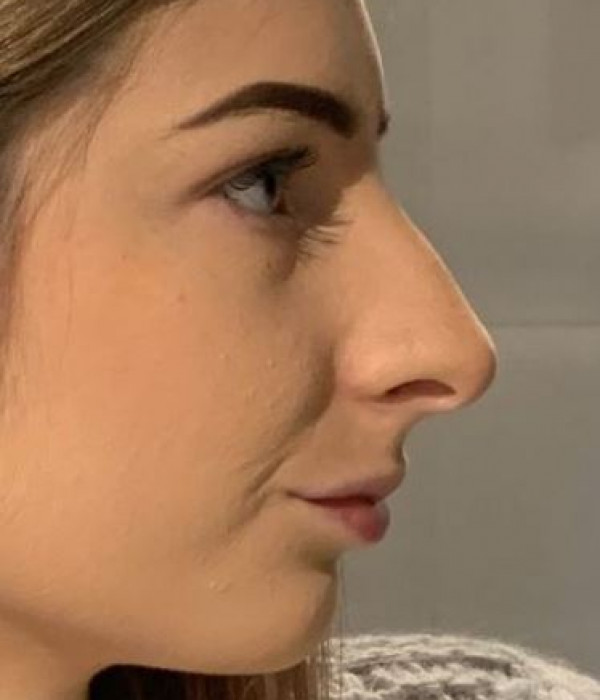 Courtney Leigh rhino before v2
