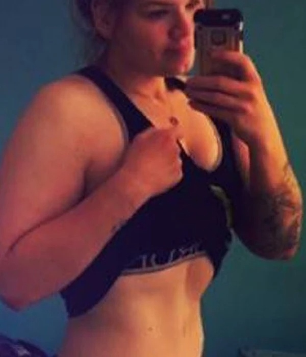 tummy tuck after5