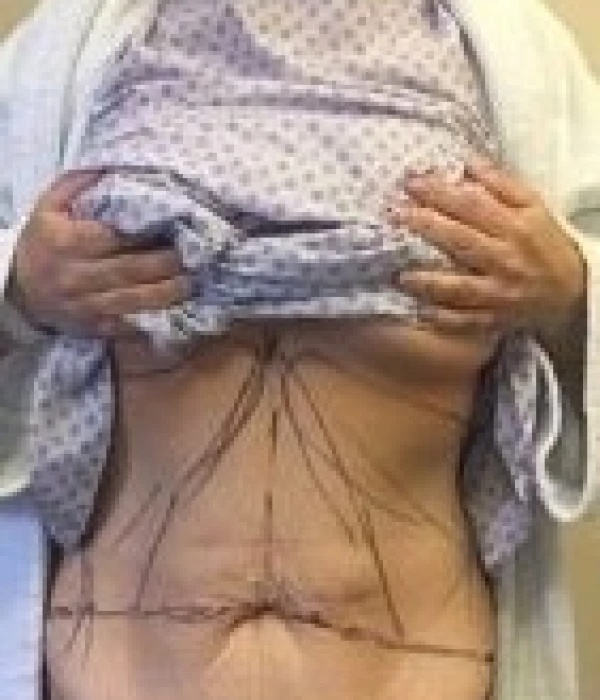 tummy tuck before4