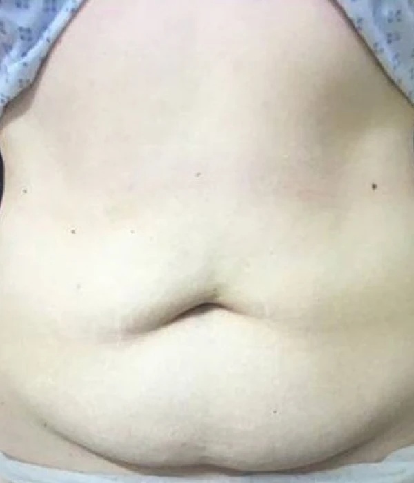 tummy tuck before5