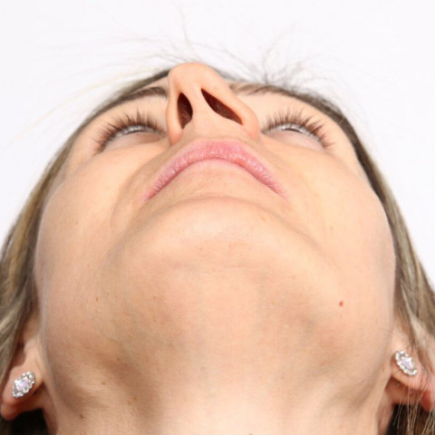 what is septoplasty