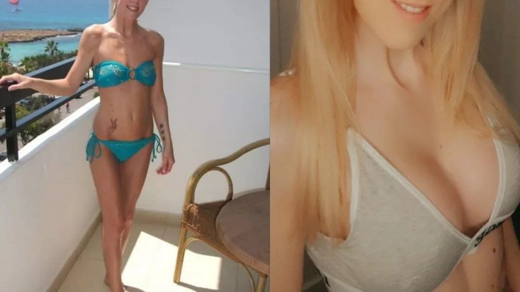 Heather's breast augmentation story