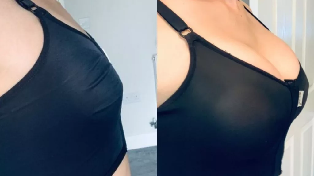 Lauren's breast augmentation story