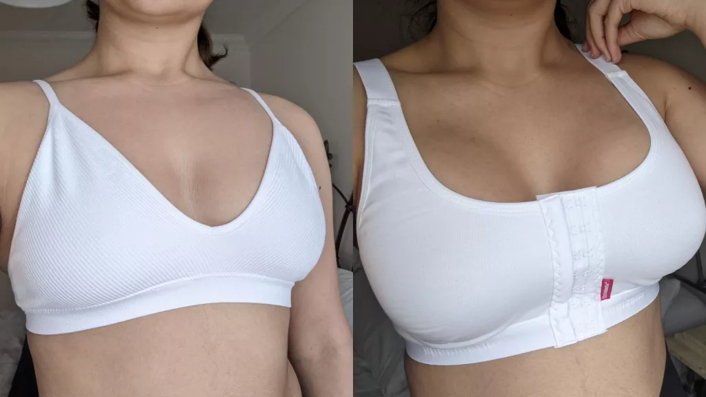 Mia's breast augmentation story
