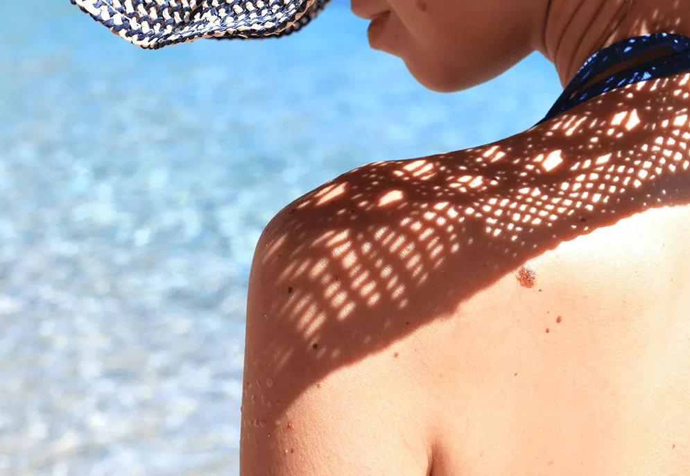 MOLES AND MELANOMA: SUMMER SKIN PROTECTION