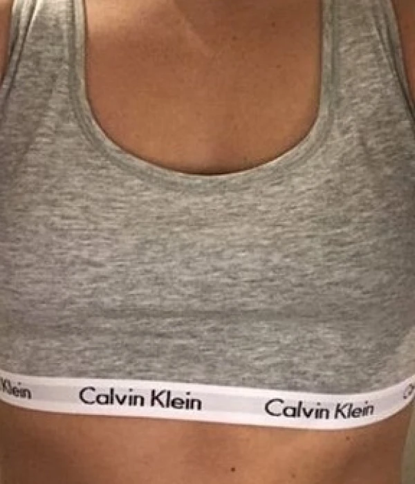 Breast enlargement before surgery, example 5